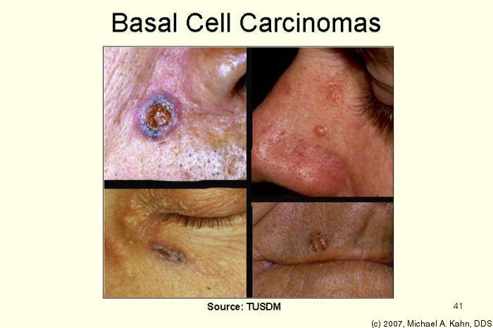 Basal Cell Carcinomas