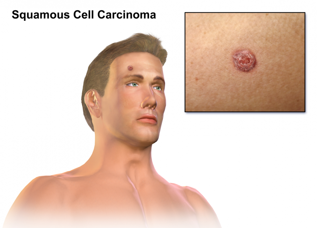 https://upload.wikimedia.org/wikipedia/commons/5/5f/Squamous_Cell_Carcinoma.png